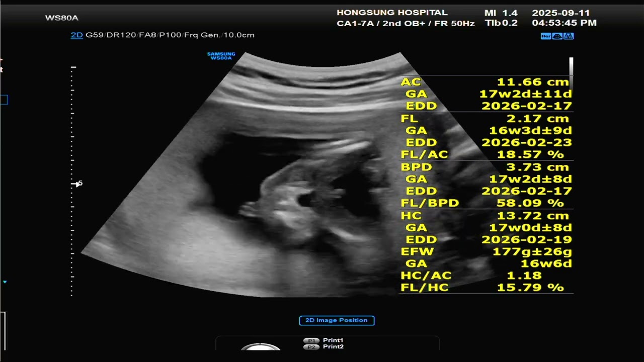 👶🏻쏘콩이 초음파 동영상 촬영(17주)❤️