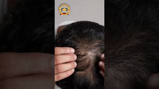 GFC vs Hair Transplant - Which One Should You Get for Hair Loss? #hairlosstreatment #hairloss