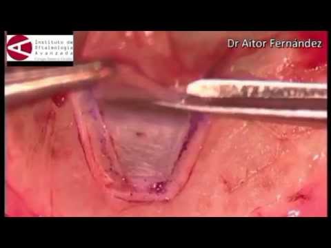 Esclerectomia profunda no perforante- EPNP (Dr Ait...