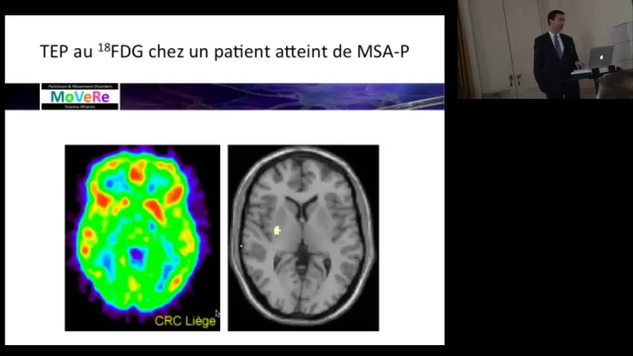 Gaëtan Garraux: NOUVEAUX MARQUEURS NEURORADIOLOGIQUES DE LA MALADIE DE PARKINSON