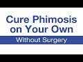Cure Phimosis on your own, without circumcision - Glansie Video