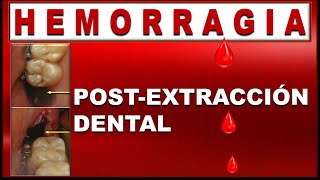 BLEEDING ALVEOLUS OR HEMORRHAGE AFTER TOOTH EXTRACTION