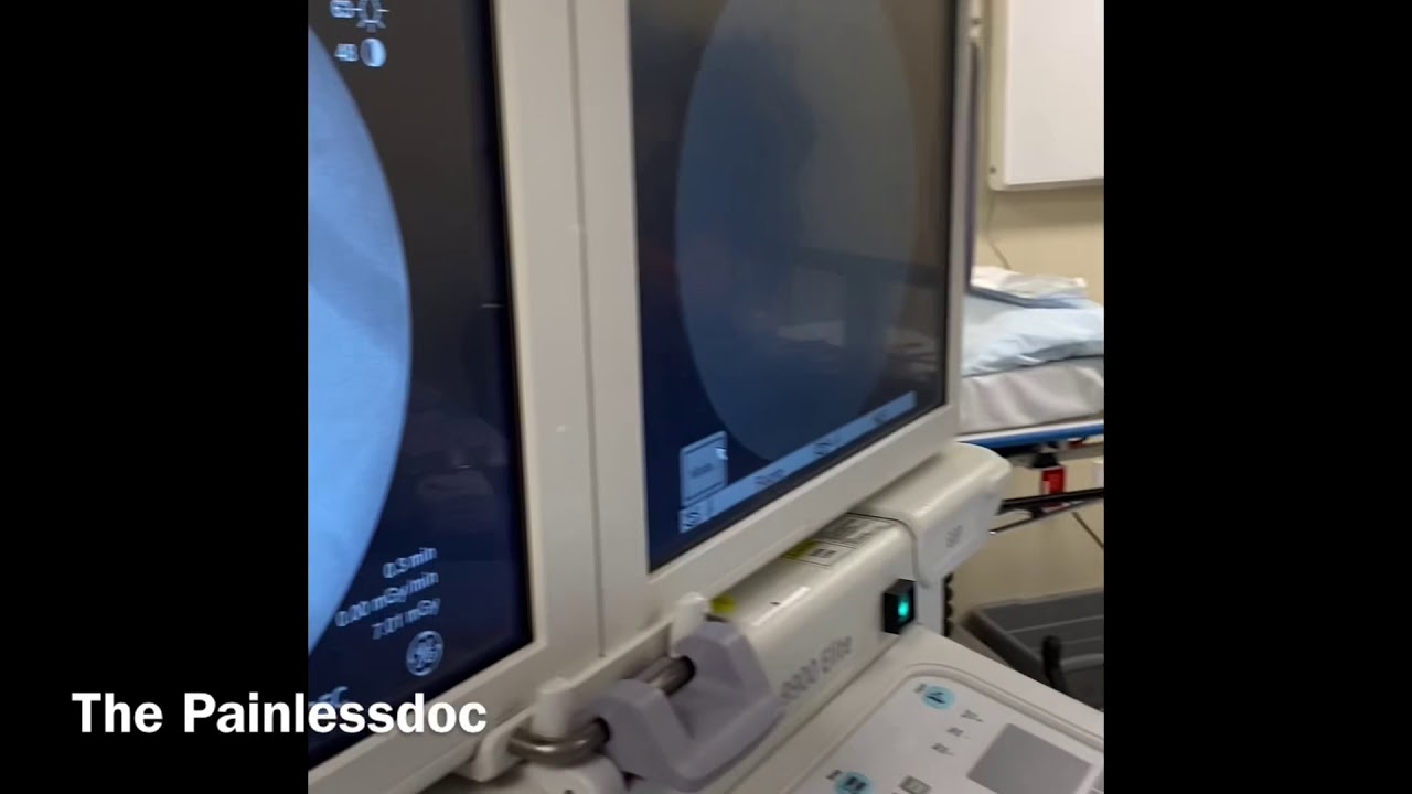 Spinal Cord Stimulator YouTube