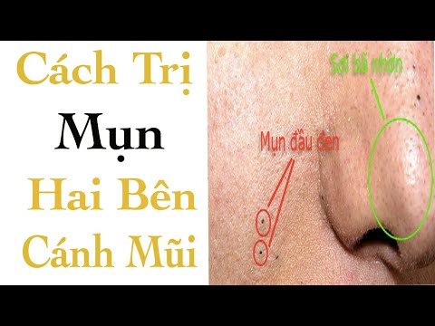 Cách Trị Mụn Hai Bên Cánh Mũi - Mỹ Phẩm SOSENCO