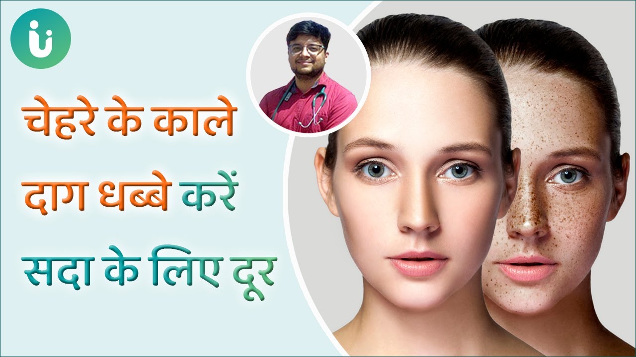 Remove pigmentation freckles and dark spots from the face forever by Dr Ayush Pandey