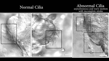 Image-Based Tool Detects Abnormal Motion of Cilia in Patients