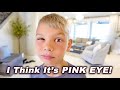 Pink Eye Is NOT GOOD!