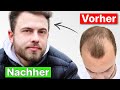 Volle und dichte haare nach 8 monaten  tims haartransplantation erfahrung