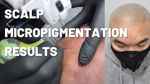 Scalp Micropigmentation Process, Natural and Realistic Results