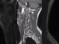 Mri cervical spine #anatomy #back #lumbarspine #spine #radiology #radiography #mriscan#mri #mrispine