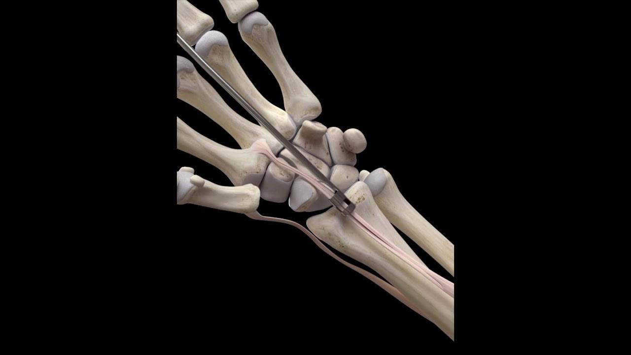 Trapeziectomy Weilby Procedure 3D Medical Animation YouTube
