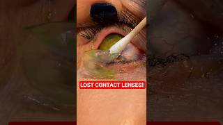 World Record: Lost Contact Lenses?!
