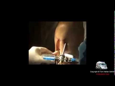 Ön Çapraz Bağ Ameliyatı | Ambulans Clup