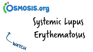 Download lagu Systemic Lupus Erythematosus Clinical Presentation Systemic Lupus Erythematosus Clinical Presentation