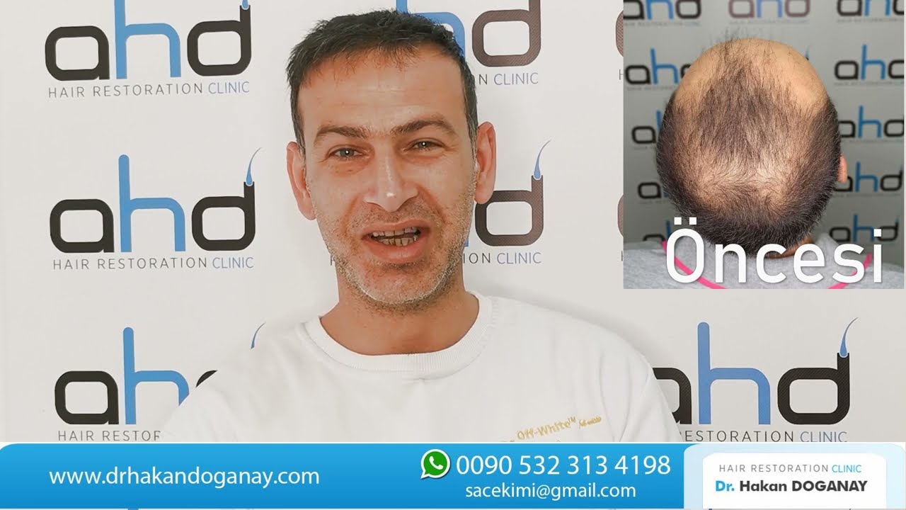 5500 графтов | Результат пересадки | Доктор Хакан ДОГАНАЙ
