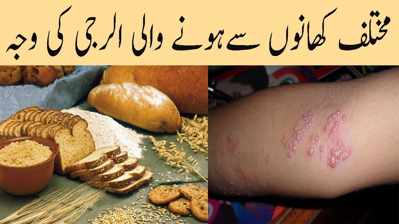 Khane Ki Chezon Se Allergy Ki Wajah Food Allergy Ki Alamat Food