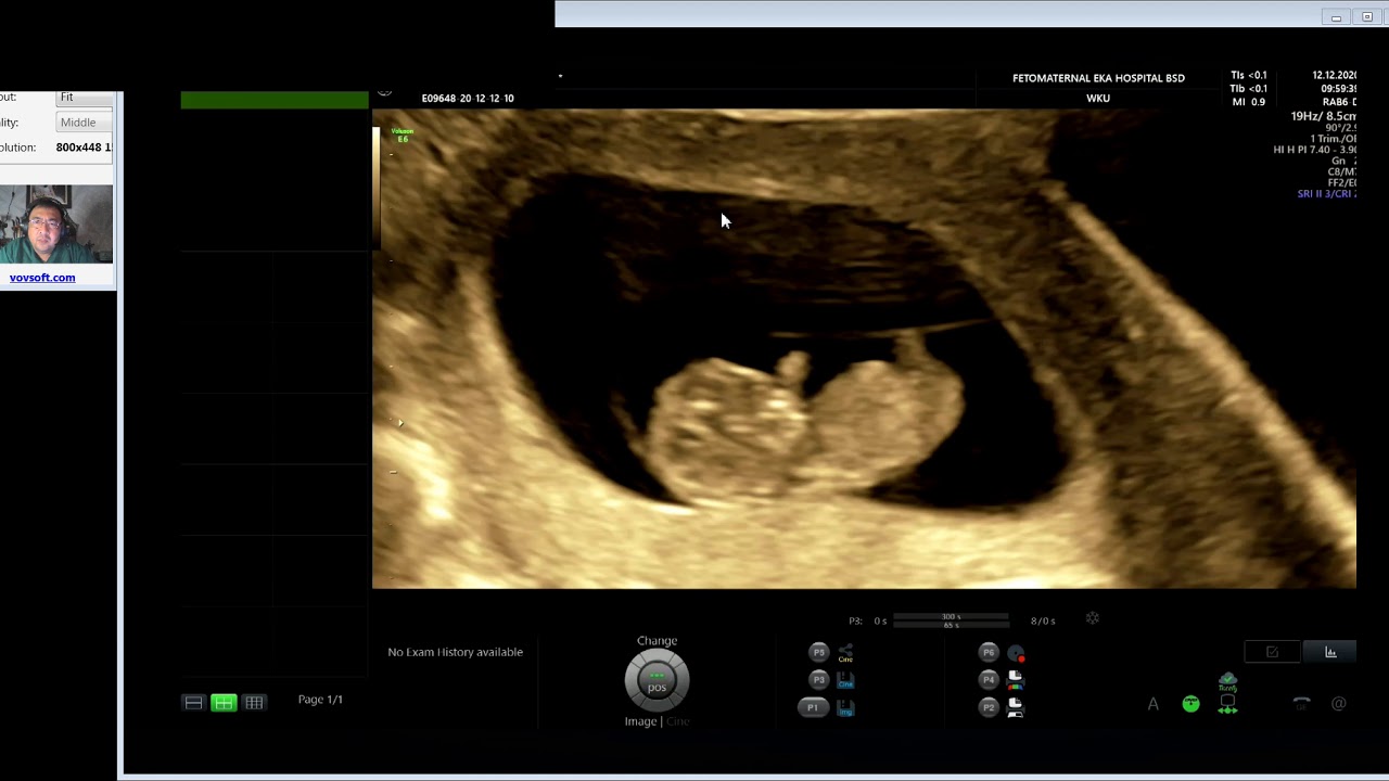 EMBRIO 9-10 MINGGU NORMAL (Dr Wiku Andonotopo)