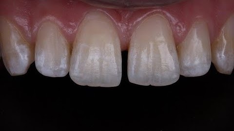 Direct compoSite veneers demo using simplified approach with unica matrix
