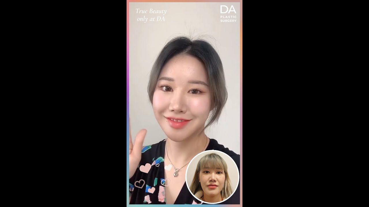 [Plastic Surgery in Korea] Recovery Process After Rhinoplasty and Facial Contouring Surgery 