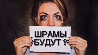 ШРАМ ОСТАНЕТСЯ 😱 | РУБЦЫ ПОСЛЕ УДАЛЕНИЯ ФИБРОАДЕНОМЫ