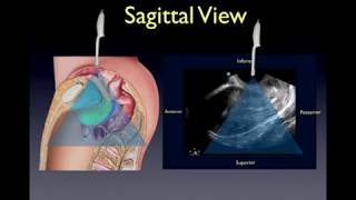 Transvaginal Pelvic Ultrasound Lecture