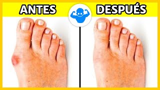 ¿Cómo eliminar juanetes con hojas de laurel?
