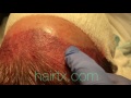 Dallas Female Hairline Lowering Recipient Site Design