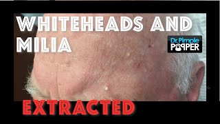 Whiteheads and milia extracted after Mohs surgery screenshot 2