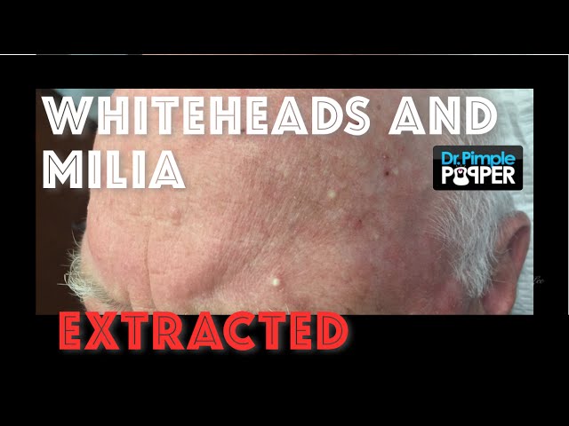 Whiteheads milia extracted after Mohs surgery - YouTube