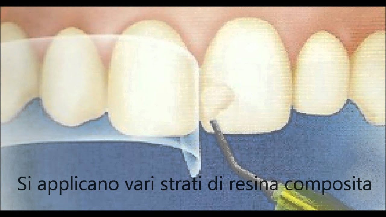 Otturazione Colletto Dentale Prima E Dopo dott Montironi dentista - OTTURAZIONE ESTETICA ANTERIORE - CONSERVATIVA