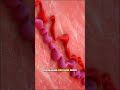 Varicose veins:A common condition with Effective Modern management#education#viral #srhu