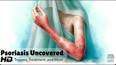 Psoriasis Uncovered: Understanding Causes, Triggers, and Effective Treatments