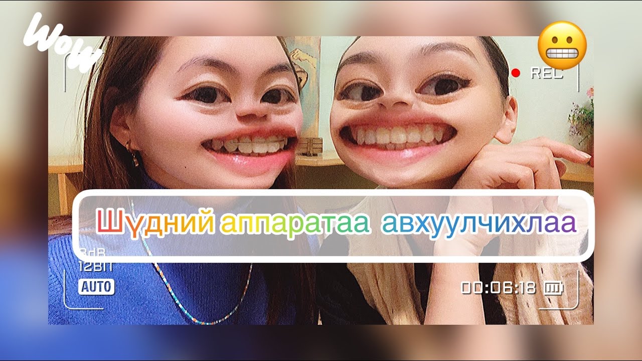 #Шүдний_аппаратаа_авхуулчихлаа 😬