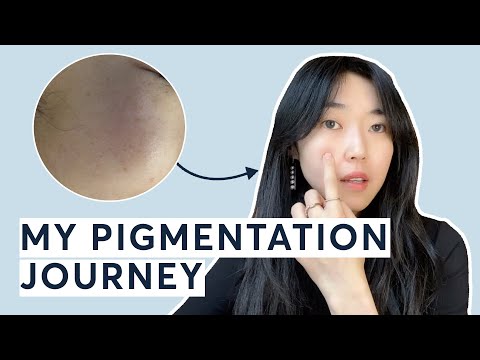 How I got rid of my pigmentation & dark spots | PicoWay Resolve
