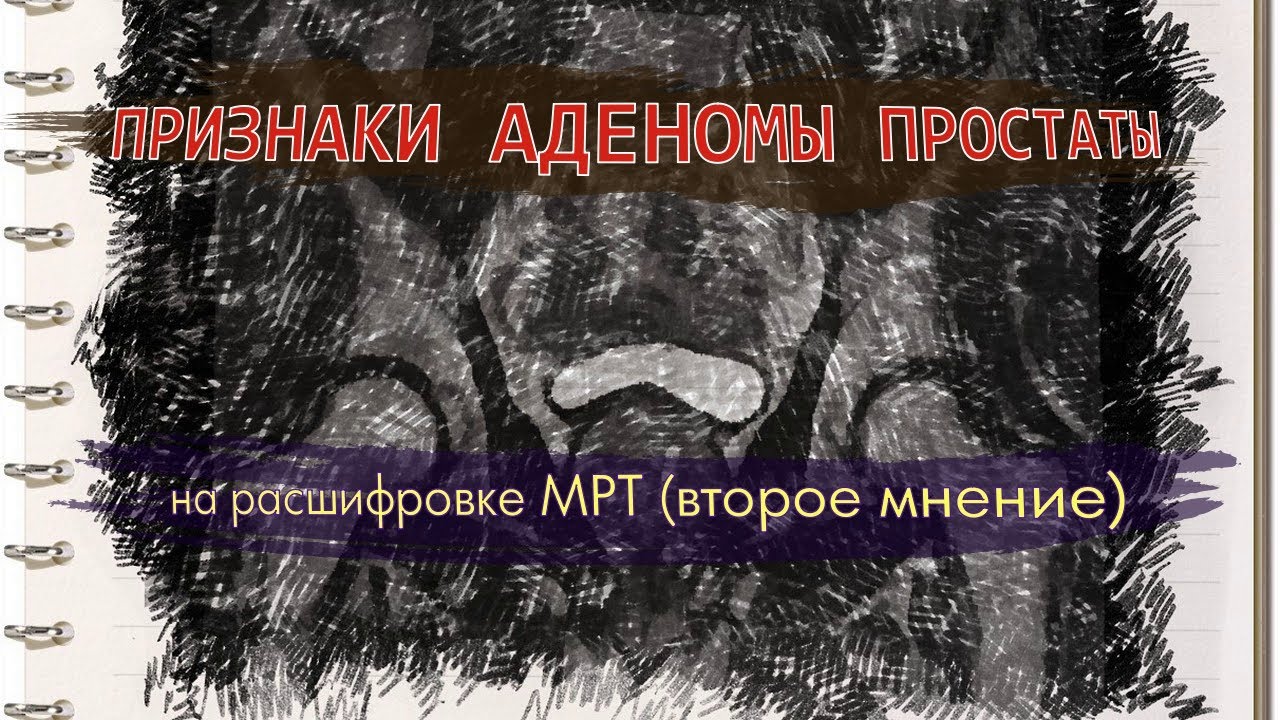 Признаки ХРОНИЧЕСКОГО ПРОСТАТИТА у мужчин и АДЕНОМА ПРОСТАТЫ на расшифровке МРТ малого таза