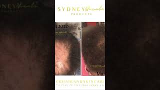 Bald spot Went From Wide to Where 👁️👀 #sydneynicoleproducts #blackhairgrowth #naturalhair #hair