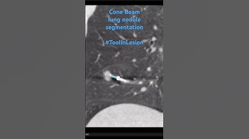Lung nodule cone beam segmentation