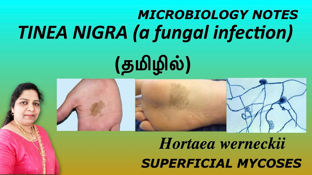 Dermatoscopy in the diagnosis of tinea nigra