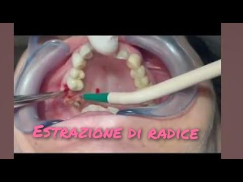 Video: 3 semplici modi per trattare una radice del dente esposta