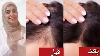 وصفات طبيعية فعالة للتخلص من تساقط الشعر نهائيا