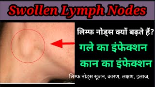 कान के पीछे गांठ .लिम्फ नोड्स सूजन, कारण, लक्षण, Swollen Lymph Nodes treatment, Causes, Symptoms .