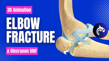 Elbow (Olecranon) Fracture and Fixation - 3D Animation