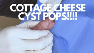 Ooey Gooey Nacho Cheese Cyst EXPLODES! | CONTOUR DERMATOLOGY