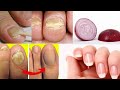 Do you suffer from nail fungus?  You have to do this!!!!  *** VERY IMPORTANT TIP ***