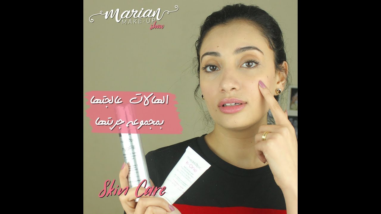 علاج الهالات السوداء | Marian Samir