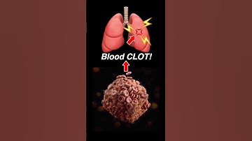Doctor Explains: PULMONARY EMBOLISM 🫁💥