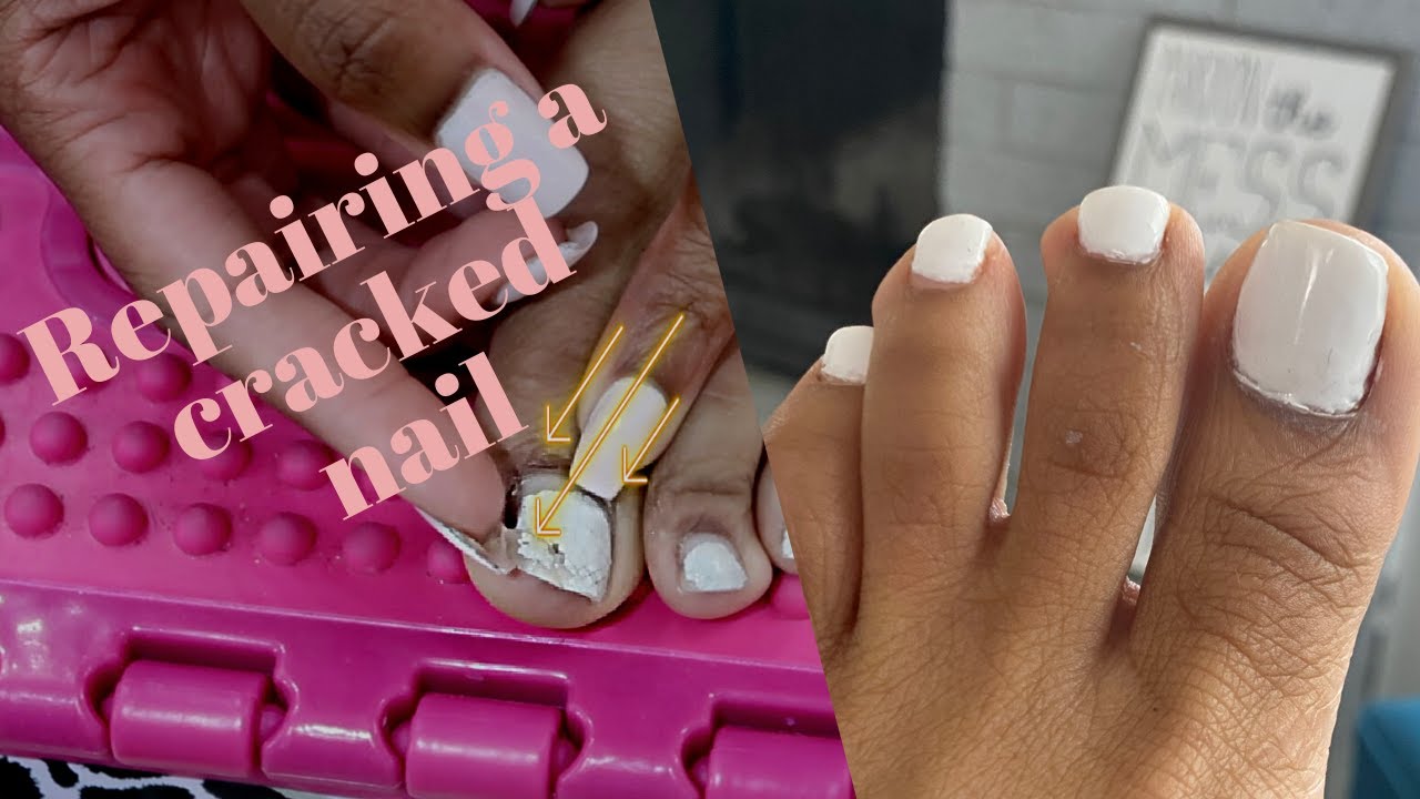 How to Repair a crack in your nail | Toe Nail repair | Easy Fix - YouTube