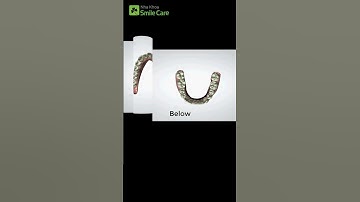 Smilesalign - Niềng khay trong suốt số 1 Việt Nam