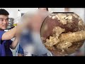 👂💤 耳かき | 耳掃除 | プラークがたくさんある 💖 DR. LAI MINH TUAN