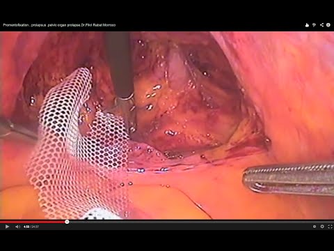 Laparoscopic Sacrocolpopexy . Promentofixation . Prolapsus .pelvic Organ Prolapse.Dr.Fikri Morroco